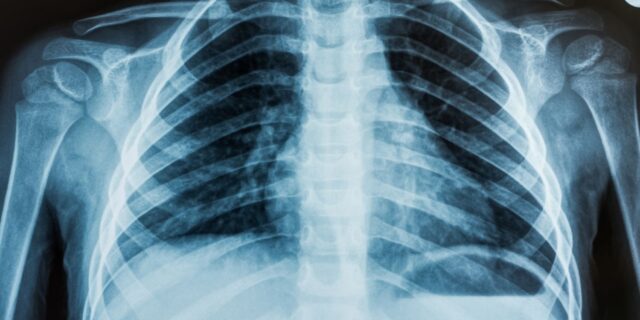 OTD in 1896: College students illegally produced America’s first X-ray photo.