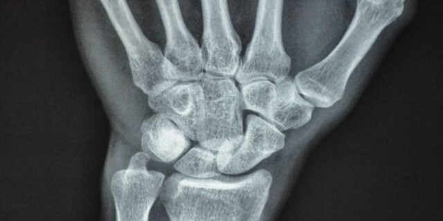 OTD in 1895: German physicist Wilhelm Conrad Röntgen discovered x-rays.