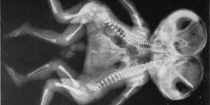 OTD in 1953: Conjoined twins were successfully separated for the first time.