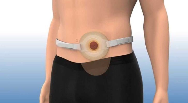 An illustration of a stoma bag around someones waist