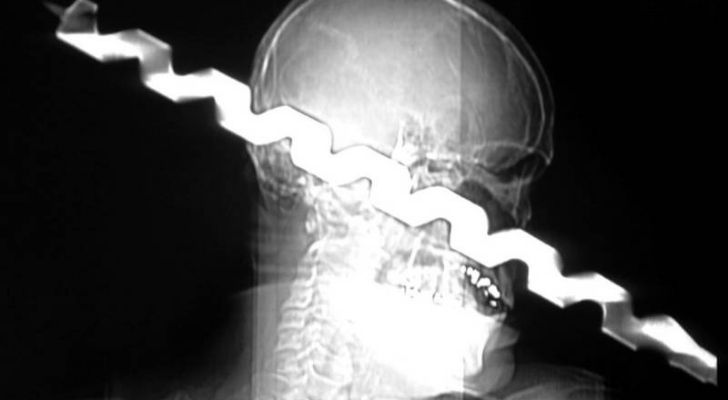 An X-Ray of a drill going right through someones head