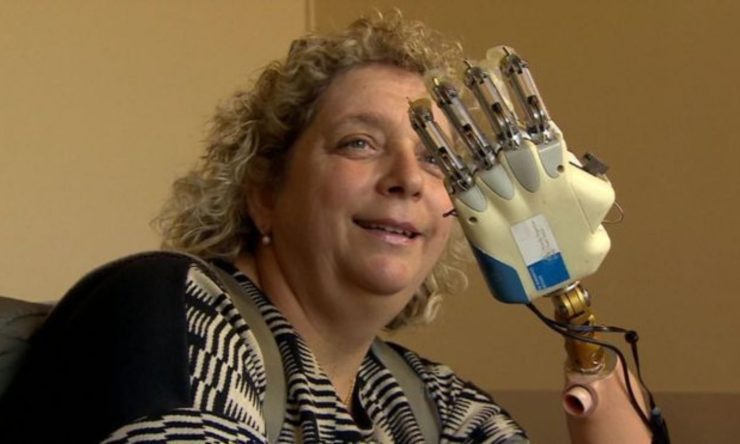 OTD in 2018: A woman in Rome became the first person to receive a bionic hand that can sense touch.