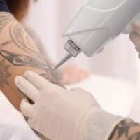 August 14: National Tattoo Removal Day