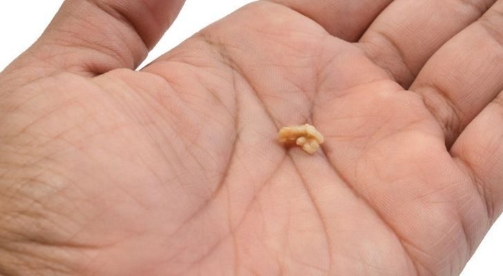 A person holding a piece of tonsil stone