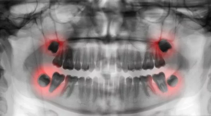 An X-Ray of teeth with the wisdom teeth shown in red