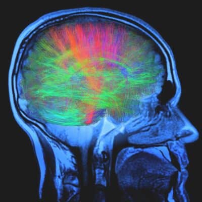 Side view MRI scan showing colorful neural pathways in the human brain
