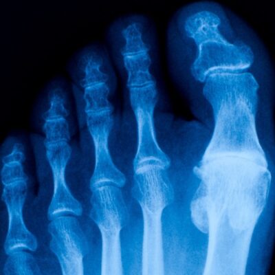 X-ray of a foot showing the big toe with two bones and other toes with three