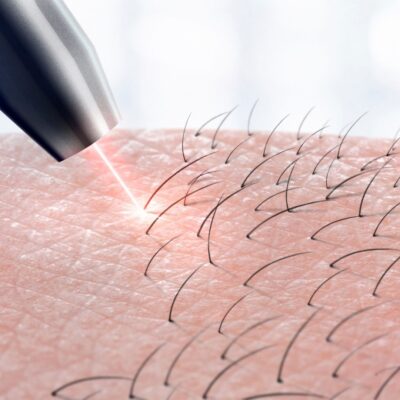 Laser device emitting red light onto skin with visible hair growth