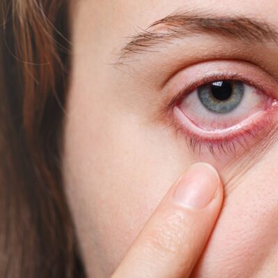 Close-up of a tired, red eye with a finger pulling down the lower eyelid